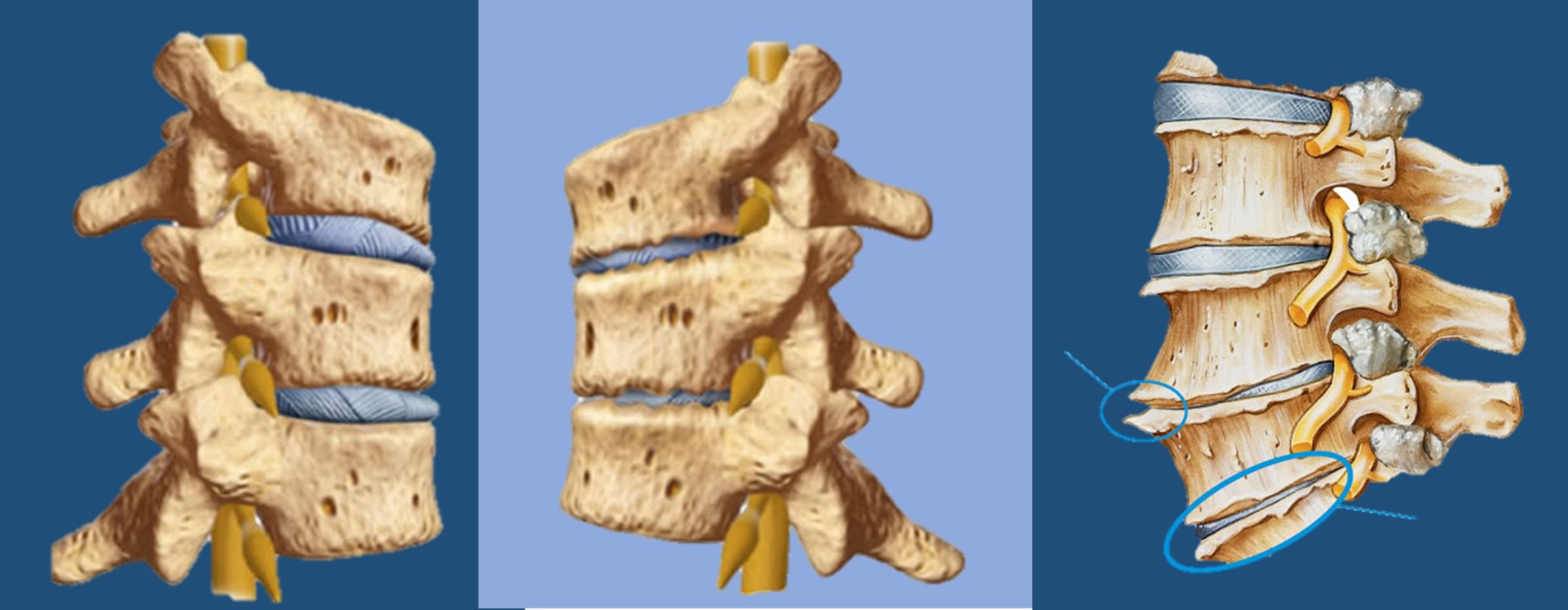 Ilustración panorámica de tres fragmentos de columna que muestra los procesos de la discopatía degenerativa