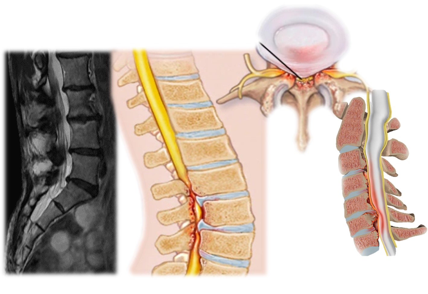 RM + 2 ilustraciones que muestran una estenosis foramenal lumbar y cervical