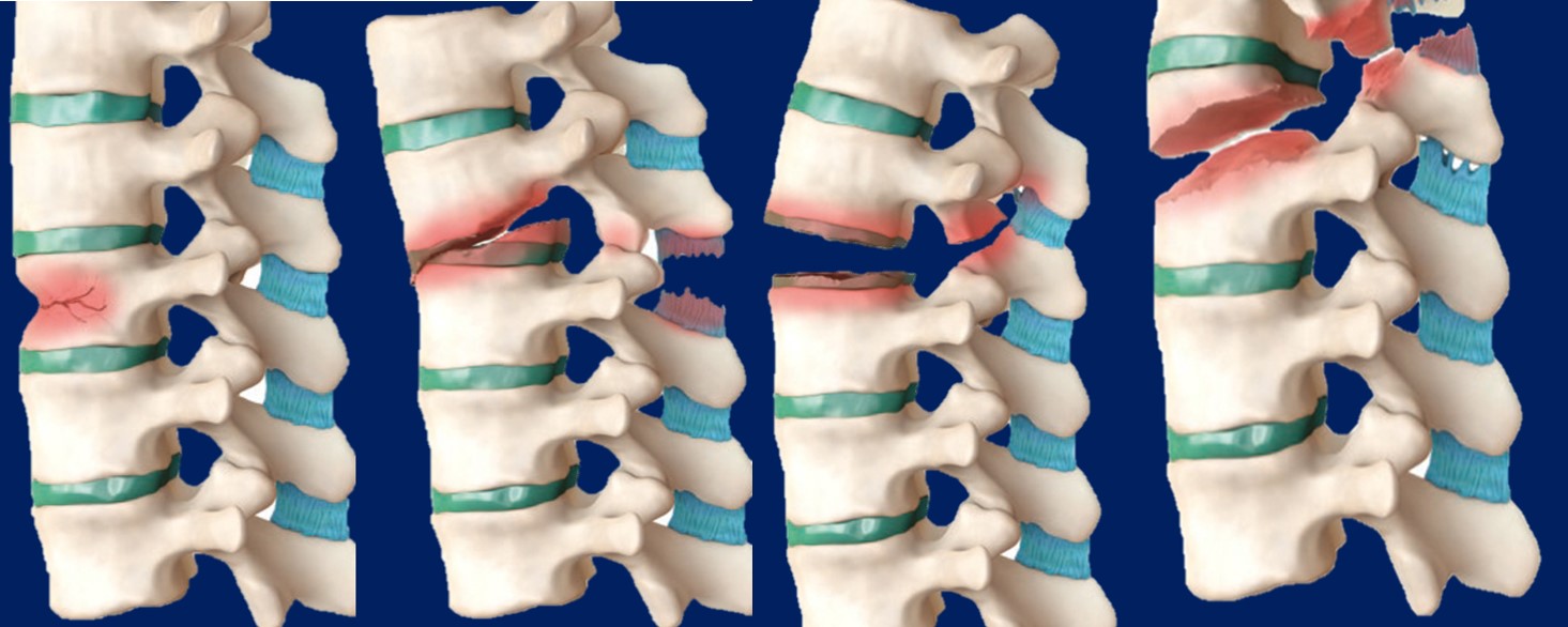 Ilustración de diferentes tipos de fracturas traumáticas 