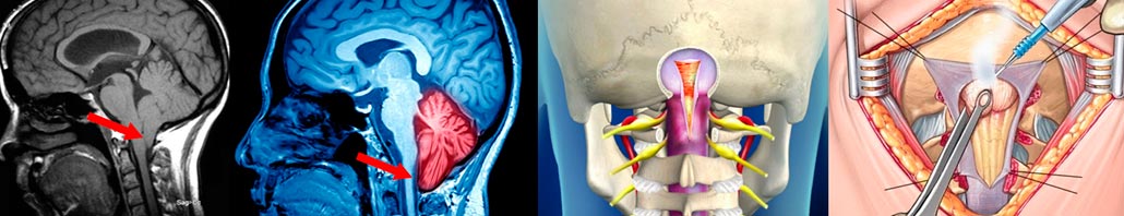 Malformación de Arnold Chiari