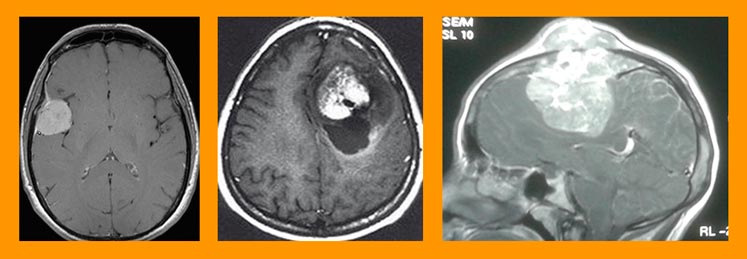 Tumores cerebrales